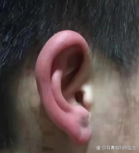 耳朵怎么通过揉变大